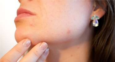 Tips for Acne Prone Skin