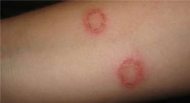 Tips to Prevent Fungal Infection